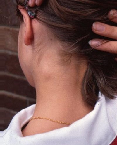 Увеличенные лимфоузлы на шее: симптомы, причины и лечение ᐉ Сеть аптек «Бажаємо здоров'я»